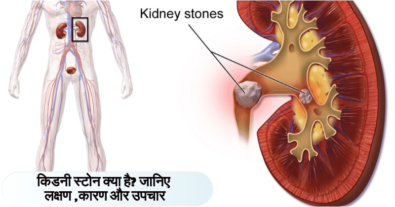 Kidney stone in hindi
